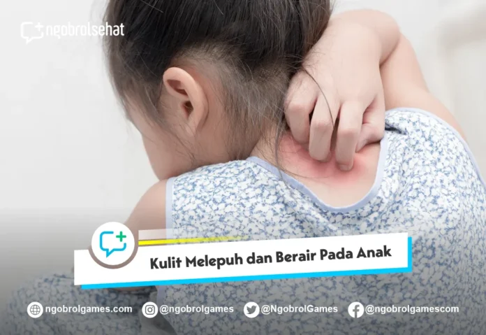 Obat Kulit Melepuh dan Berair pada Anak