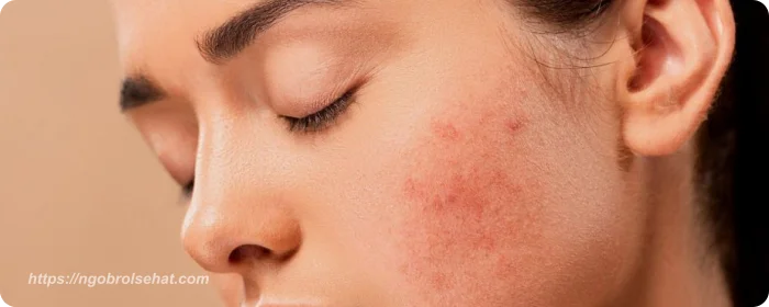 manfaat biotin untuk wajah mengatasi kulit kering dan bersisik - ngobrol sehat
