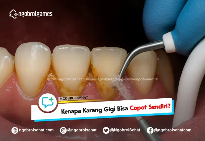 kenapa karang gigi copot sendiri - ngobrol sehat